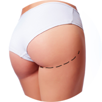 chirurgia estetica liposuzione gambe e glutei